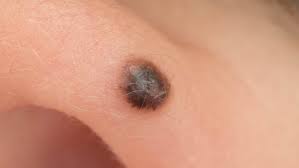 Image result for Spitz Nevus