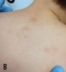 Image result for Urticaria pigmentosa children