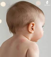 Image result for sweat rash on back baby