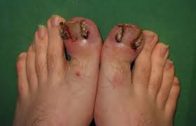 See full list on wikihow.com Surgical Treatment Of Ingrown Toenails Wikiwand