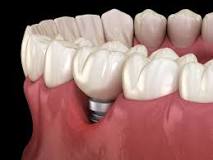 The Pros and Cons of Titanium Dental Implants | Chicago ...