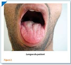 What are the symptoms of myasthenia gravis? Myasthenie Et Atrophie De La Langue Semantic Scholar