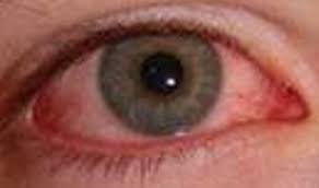 Can A Herpes Infection Really Cause Blindness