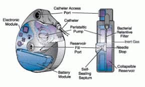 Image result for Intrathecal Pump