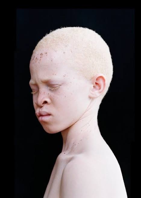Mga resulta ng larawan para sa African Boy with albinism"