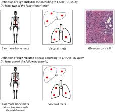 Going Towards A Precise Definition Of The Therapeutic Management Of De Novo Metastatic Castration Sensitive Prostate Cancer Patients How Prognostic Classification Impact Treatment Decisions Sciencedirect