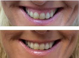 People consider fuller lips to be attractive because they are a sign of youth and vitality. Dr Teri Describes How She Treats Gummy Smiles With Botox In Cheshire