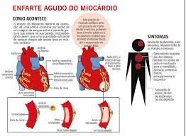 O enfarte agudo do miocárdio, vulgarmente conhecido como ataque cardíaco, ocorre quando uma das artérias do coração fica obstruída por um coágulo, o que faz com que uma parte do músculo. Do Enfarte Agudo Do Miocardio Ao Assumir Da Doenca Mundo Portugues