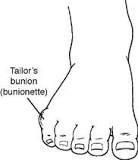 Image result for what is the treatment for bunionettes