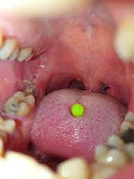 What to expect impacted teeth after your oral surgery patient. Blood Clot Wisdom Tooth Extraction Novocom Top
