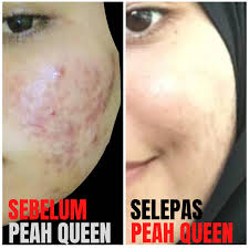Semoga mampu sedikit menambah wawasan sobat cantik & sobat. Cara Menghilangkan Jerawat Dengan Suplemen Vitamin C Peah Queen Vitamins Skin Care Shopee Malaysia