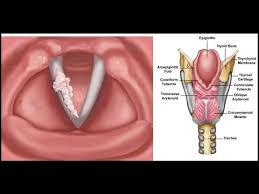 Gırtlak, gırtlağın hemen altında bulunan ses kutusuyla yakın. Girtlak Kanseri Ses Kisikligi Sigara Iliskisi Op Dr Ali Ahmet Sirin Kbb Ve Bas Boyun Cerrahisi Uzmani