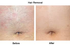 Zap your way to silky smooth skin! Laser Hair Removal Campbelltown Mount Annan Camden Park Narellan