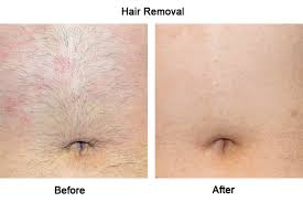 The area might also be slightly swollen or red. Laser Hair Removal Campbelltown Mount Annan Camden Park Narellan