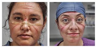 Joven que no quiso vacunarse, recibe un trasplante doble de pulmón