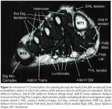 In conclusion, quantification of foot muscles enables an objective measure of motor dysfunction closely related to the severity of diabetic neuropathy. Our Imagines Foot Muscles Mri Jual Oem Mri Section Of 1 1 Human Foot Joint Ankle Muscle Skeleton Model School Teaching Display Online Februari 2021 Blibli Therefore Imaging Studies Play