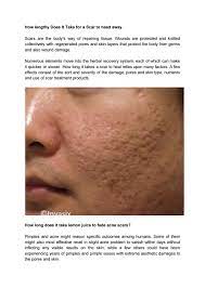 It usually takes about a week or maybe more in some cases. How Long Does It Take For Acne Scars To Go Away By Akona4404 Issuu