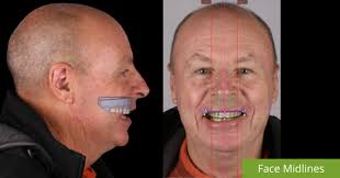 How do we use 3D facial design for your smile makeover? Case Study