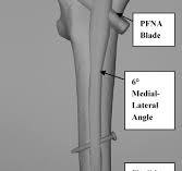 The AO/ASIF proximal femoral nail antirotation (PFNA): A new ...