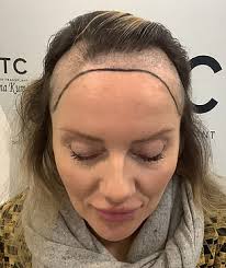 My thinning middle-aged hair left me in despair. Then I hit