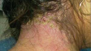 Image result for white scabs on the head in children