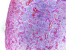 Inflammation Wikipedia
