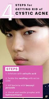 4 Ways To Get Rid Of A Cystic Pimple Fast Cystic Acne Remedies Cystic Acne Cystic Acne Treatment