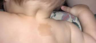 cocuklarda deri lekelerine dikkat