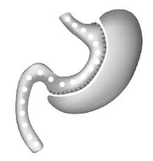 Sleeve Gastrectomy General Surgeon Gold Coast Weight Loss Surgery Bariatric Surgery Liver Surgery Hernia Surgery Specialist Dr Harald Puhalla