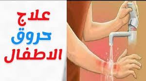 أخطاء الامهات في علاج حروق الاطفال الحقي يا ماما اخويا وقعت على ايده براد الشاي و