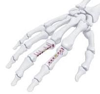 Variable Angle Locking Hand System