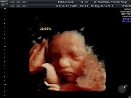 In dieser woche kann man eine schwangerschaft im ultraschall noch nicht sehen, da seit der einnistung gerade. 3d 4d Ultraschall Pranataldiaknostik