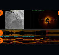 Optical Coherence Tomography (OCT) Intravascular Imaging ...