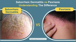 Image result for Seborrheic Dermatitis