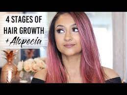 How Alopecia Works With The Hair Growth Cycle Youtube Hair Growth Cycle Hair Alopecia Hair Growth