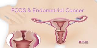 The only potential complication of endometrial cancer symptoms is anemia, a low red blood cell count. Pcos And Endometrial Cancer What Women Need To Know Pcos Nutrition Center