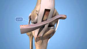 The acl ligament helps to hold the therefore, most orthopaedic surgeons recommend acl surgery treatment in the athletic population because repetitive insults to the knee as a result of. Acl Reconstruction Animation Orthoinfo Aaos
