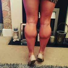Women Huge Muscular Calves Gallery Calves Muscle Women Muscular