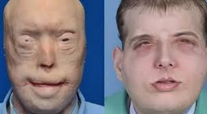 Wajah Terbakar Parah, 1 Tahun Menanti Donatur Kulit, Patrick Akhirnya Bisa  Tersenyum