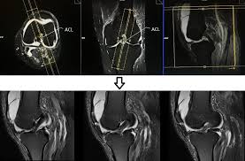 Mri Knee Protocol And Planning For Sagittal Anterior Cruciate Ligament Acl Mri Anterior Cruciate Ligament Cruciate Ligament