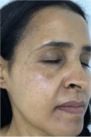 ATTDX SkinSpot Corrector TurmericSerum