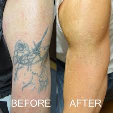 Pin On Tattoo Removal