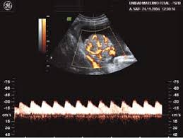 Es precisamente a las 22 semanas de embarazo¸ donde se está empezando a formar en su pequeño abdomen un páncreas incipiente que será el encargo de la de igual manera, para las 22 semanas de embarazo, es muy posible que ya puedas escuchar el latido del corazón del bebé en casa con un. Aspecto Del Corioangioma A Las 22 Semanas De Embarazo Con Flujos De Download Scientific Diagram