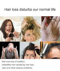 But, is shampoo really the cause of your hair fall? Sevich 200ml Ginger Hair Shampoo Natural Anti Hair Loss Shampoo Hair Loss Treatment Hair Growth Shampoos Aliexpress