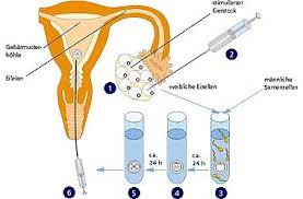 Tag mit den zellen der gebärmutterschleimhaut vollkommen bedeckt; In Vitro Fertilisation Kantonsspital Baden Ksb