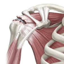 Image result for Rotator Cuff Rupture