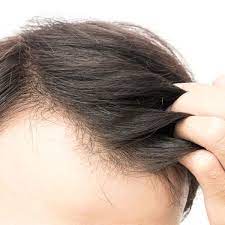 The signs of dandruff include white flakes of dead skin in the hair or even on the shoulders, and you will have itchy crusty scalp , too. Dry Scalp And How It Relates To Hair Loss Toronto Hair Transplant Clinic