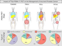 An increase in psa can mean there are prostate cancer cells in your body. Impact Of 68ga Psma 11 Pet On The Management Of Recurrent Prostate Cancer In A Prospective Single Arm Clinical Trial Journal Of Nuclear Medicine