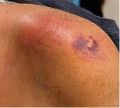 Image result for Septic Joint