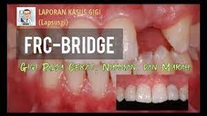 Harga gigi palsu termurah di medan kualitas bagus, kuat, nyaman jenis gigi palsu.puri dental clinic memberikan pelayanan pemasangan gigi palsu yang bagus & berkualitas. Gigi Tiruan Cekat Frc Fiber Reinforced Composite Gigi Palsu Resin Komposit Diperkuat Serat Youtube